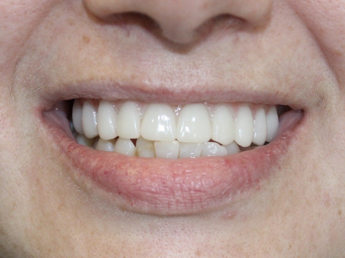 The same patient after a smile makeover at Okonic Dental, with even, bright front teeth