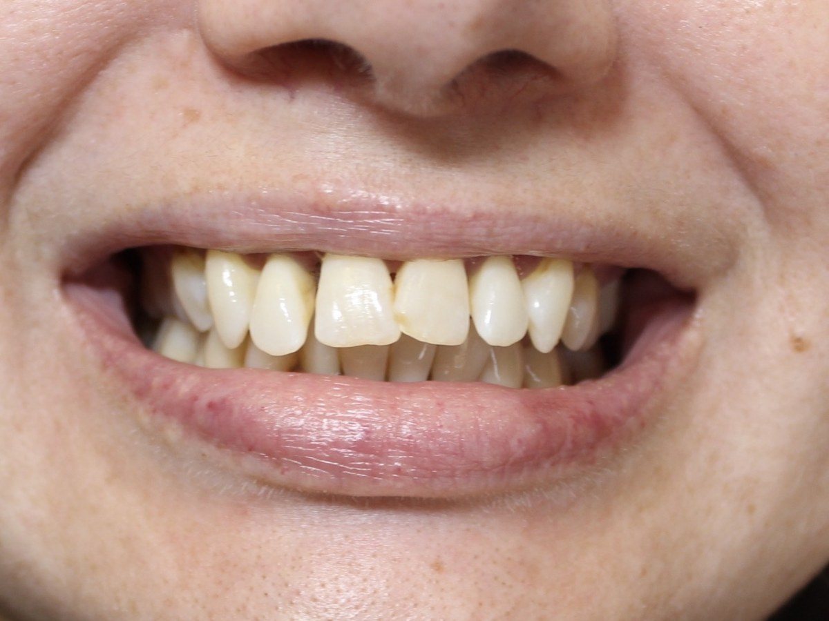 A patient's smile before treatment, with uneven and discoloured front teeth