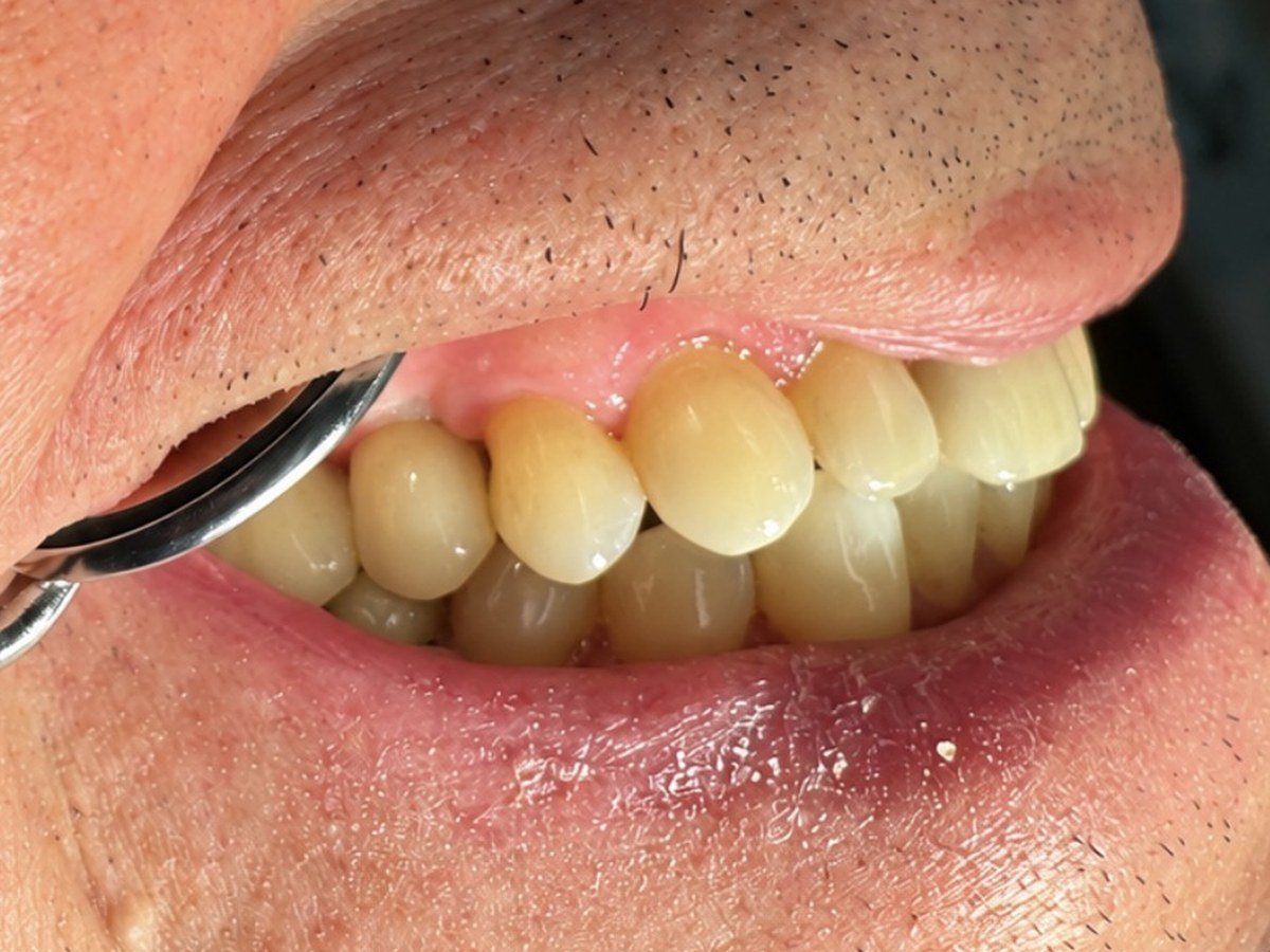 The same patient after the new implant crown was placed at Okonic Dental