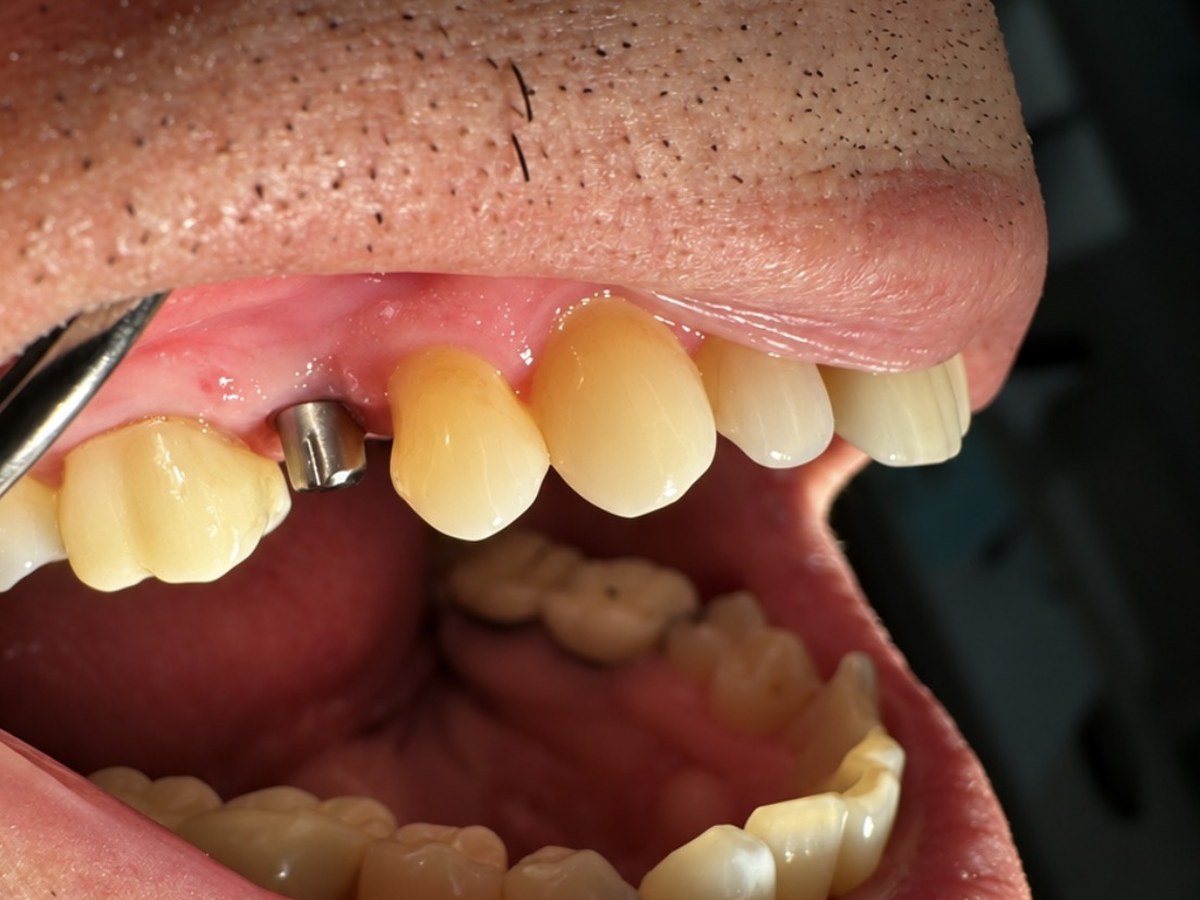 Side view of a patient's upper teeth before treatment, with a missing tooth and implant post in place