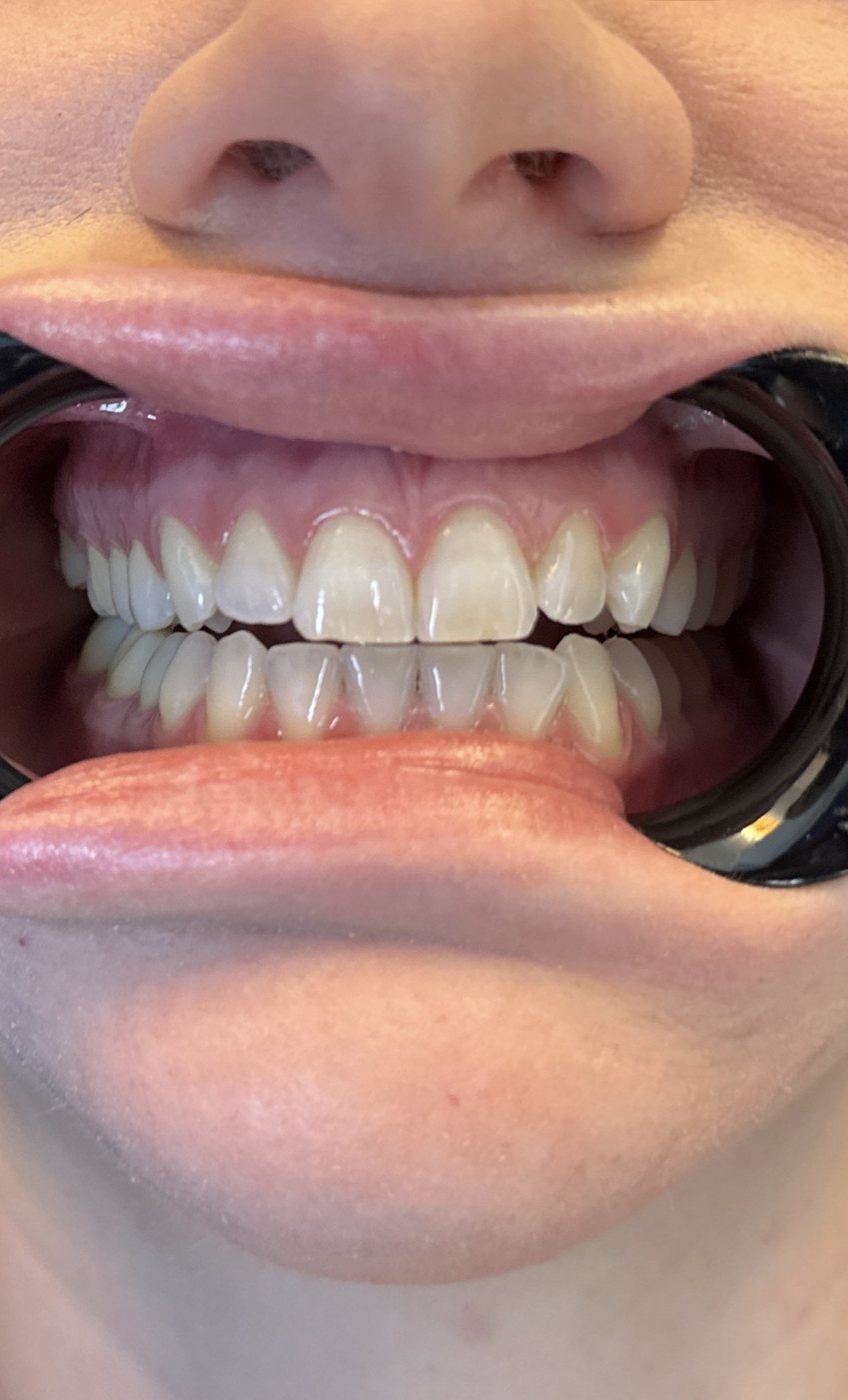 A patient's finished smile after treatment at Okonic Dental