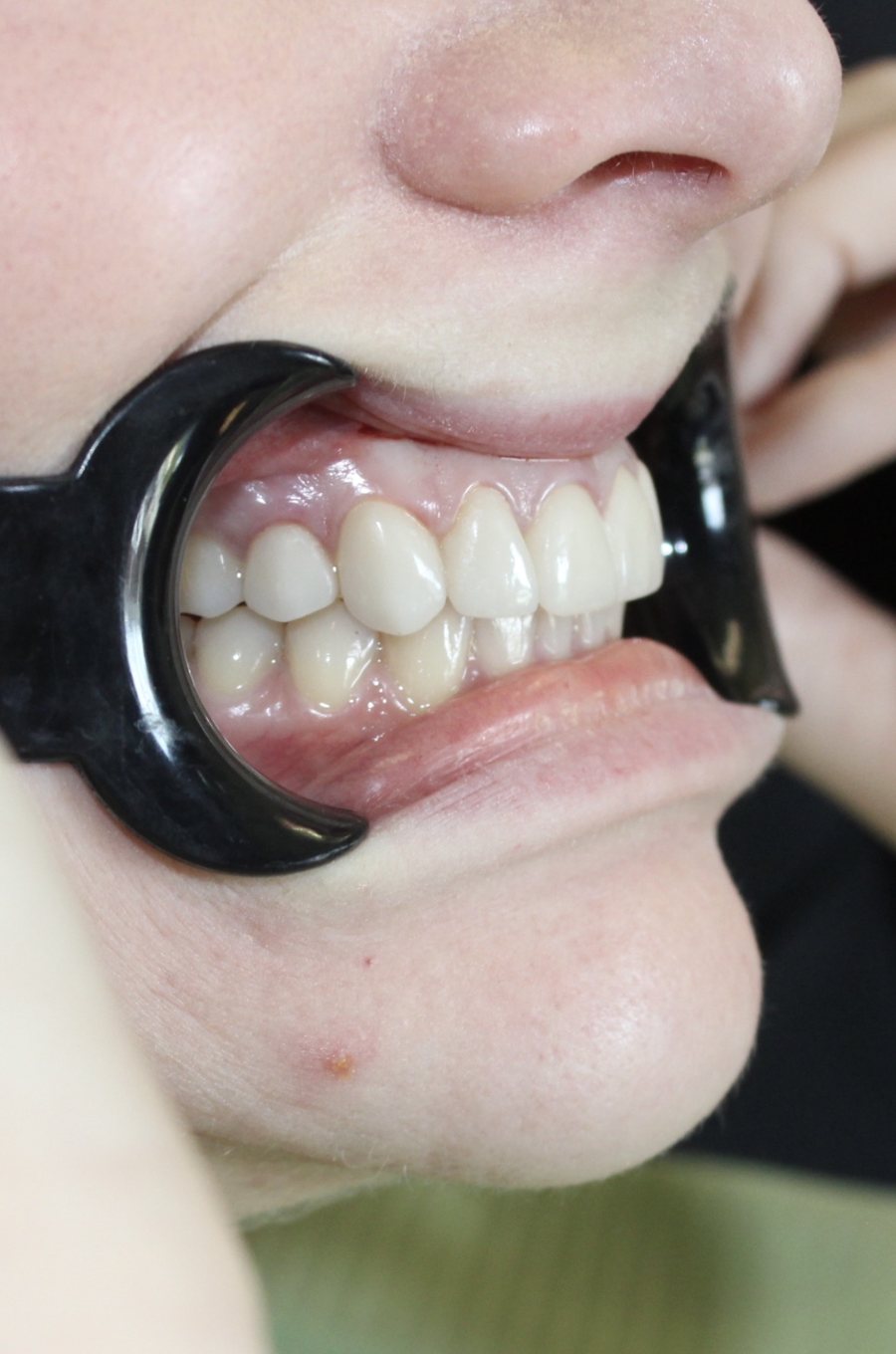 Side view of a patient's restored smile at Okonic Dental