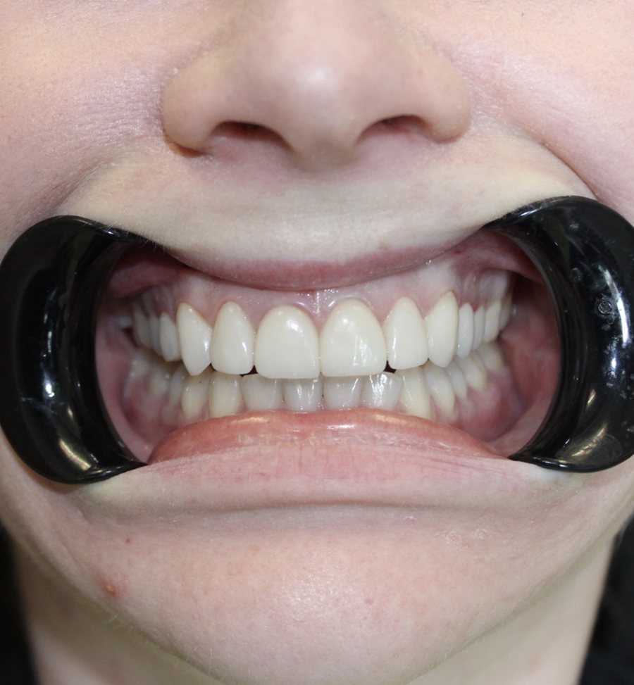 A patient's even, bright smile after treatment at Okonic Dental