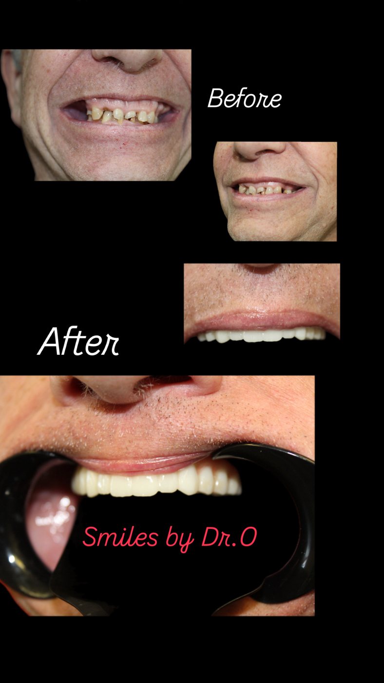 Before and after photos of a patient's full smile restoration by Dr. Okons